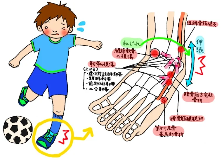 つなぎ 足部が内側にねじれる