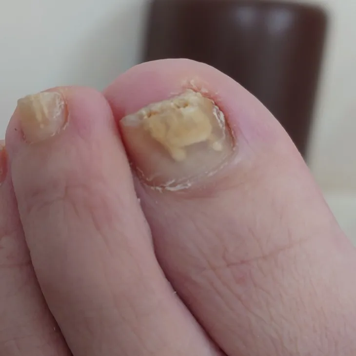 新しい爪が生えてきた